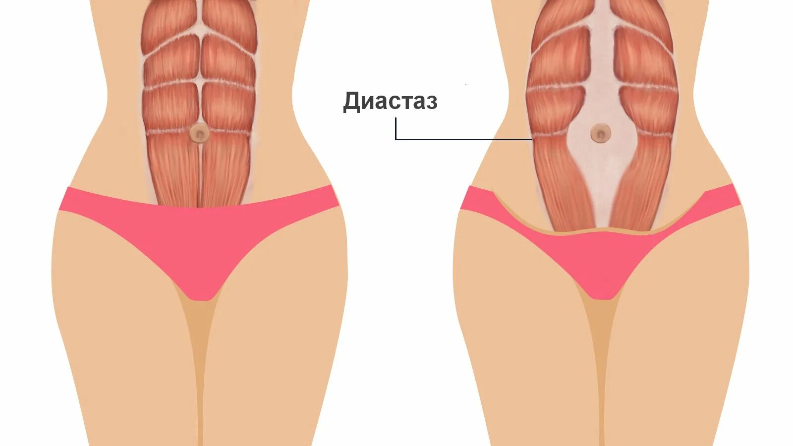 Мышцы живота анатомия диастаз. Прямые мышцы живота диастаз. Диастаз мышц белой линии живота. Прямая мышца живота диастаз.