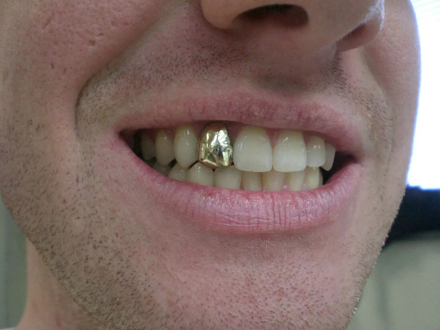 Сколько стоит металлические зубы