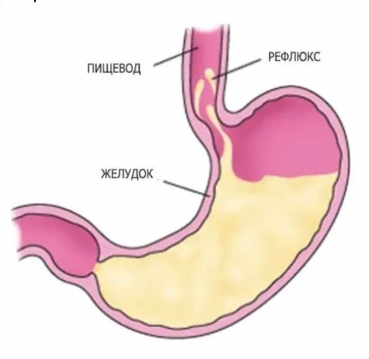 Как вылечить рефлюкс навсегда. Рефлюкс желудочного содержимого. Эзофагит рефлюкс кислотный. Желудочно-пищеводный рефлюкс пищевод. Заброс содержимого желудка в пищевод.