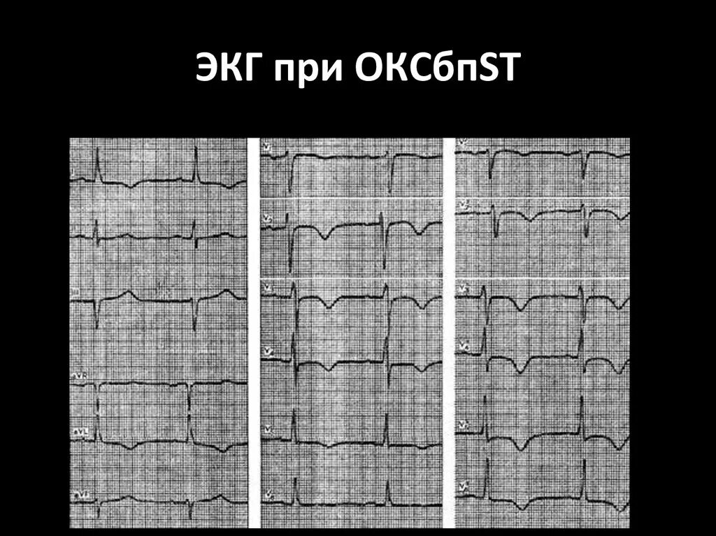 Экг подъем. Окс без подъема St ЭКГ. Острый коронарный синдром ЭКГ. ЭКГ при ЭКГ при ЭКГ при Окс. ОКСБПST на ЭКГ.