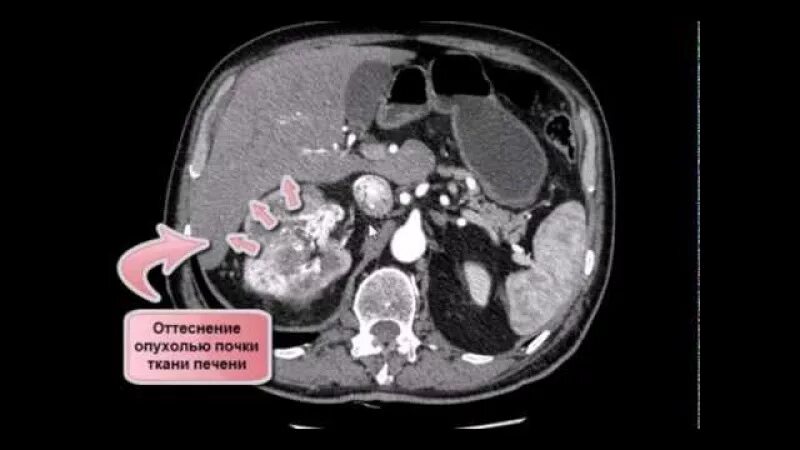 Кт брюшной полости с контрастом опухоли. Мультиспиральная кт почек опухоль. Почечно клеточная карцинома кт. Магнитно-резонансная томография почки опухоль. На кт видно опухоль