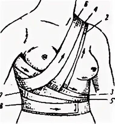 Повязка на молочные железы алгоритм. Накладывание повязки на молочную железу. Повязка Вельпо на молочную железу. Десмургия повязка на молочную железу. Схема перевязку грудной клетки.