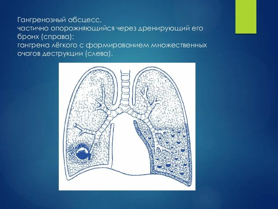 Гангренозный абсцесс рентген. Острый гангренозный абсцесс легкого. Дренирующийся абсцесс легкого. Гангренозный абсцесс легкого рентген. 1 абсцесс легкого