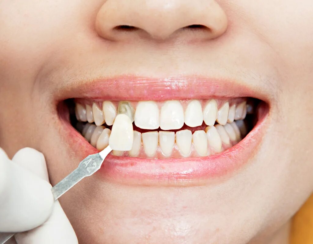 Зубная реставрация. Виниры люминиры компониры. Эстетическая стоматология виниры. Красивые зубы.