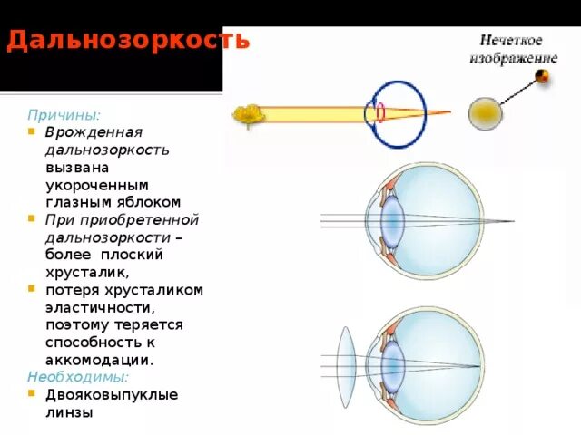 Причины возникновения дальнозоркости. Двояковыпуклая линза для дальнозоркости. Глазное яблоко при врожденной дальнозоркости. Гиперметропия двояковыпуклые линзы. Причина врожденной дальнозоркости.