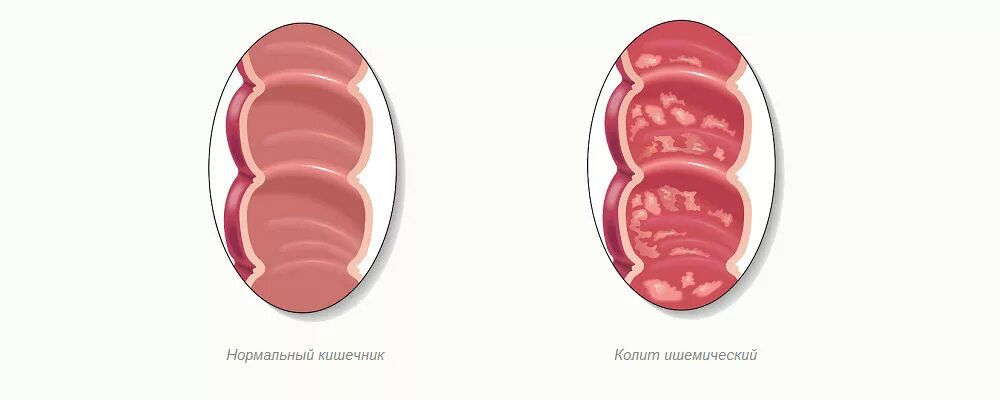 Колит слабость