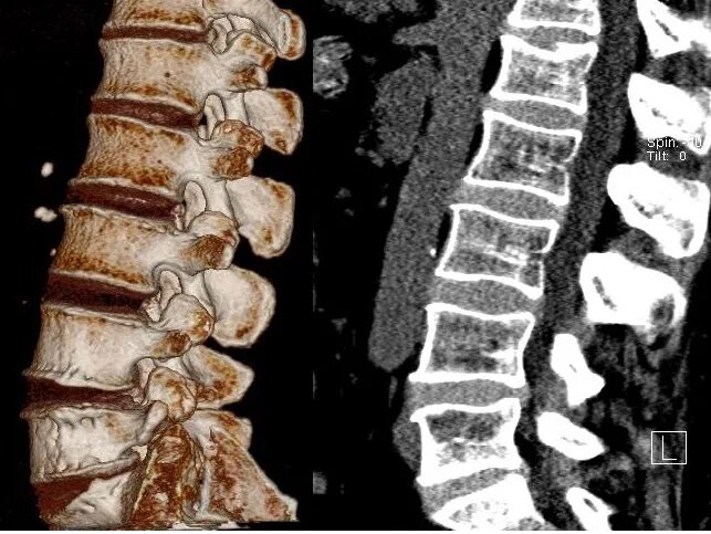Остеопороз грудного отдела позвоночника на кт. Остеопороз позвоночника поясничного отдела. Остеопороз позвонков на кт. Остеопороз позвоночника позвонках на кт.