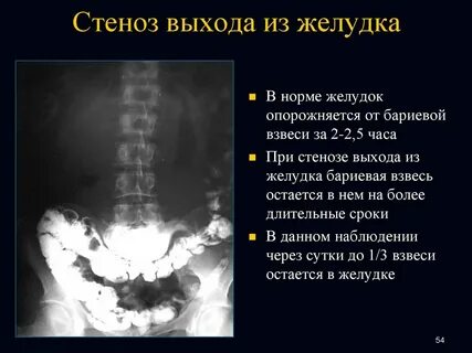 Декомпенсированный стеноз