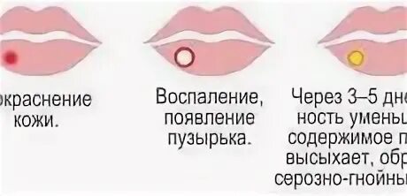 Герпес на губах начальная стадия. Герпес на губе первая стадия. Через сколько дней проходит герпес на губах. За сколько пройдет герпес на губах