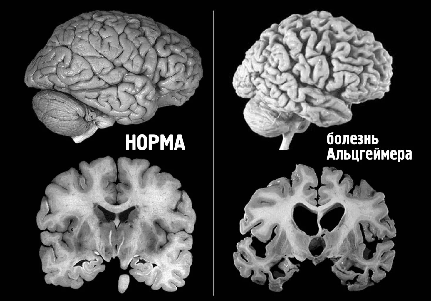 Мозг слабоумие. Болезнь Альцгеймера. Мозг при болезни Альцгеймера. Атрофические болезни мозга.