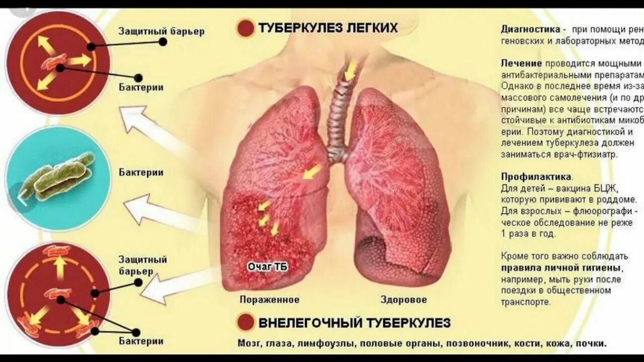 Внутренний туберкулез. Туберкулез бактериальное заболевание. Поражение органов при туберкулезе. Легкие пораженные туберкулезом. Легкие больного туберкулезом.