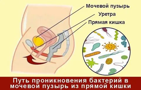Герпес мочевого пузыря