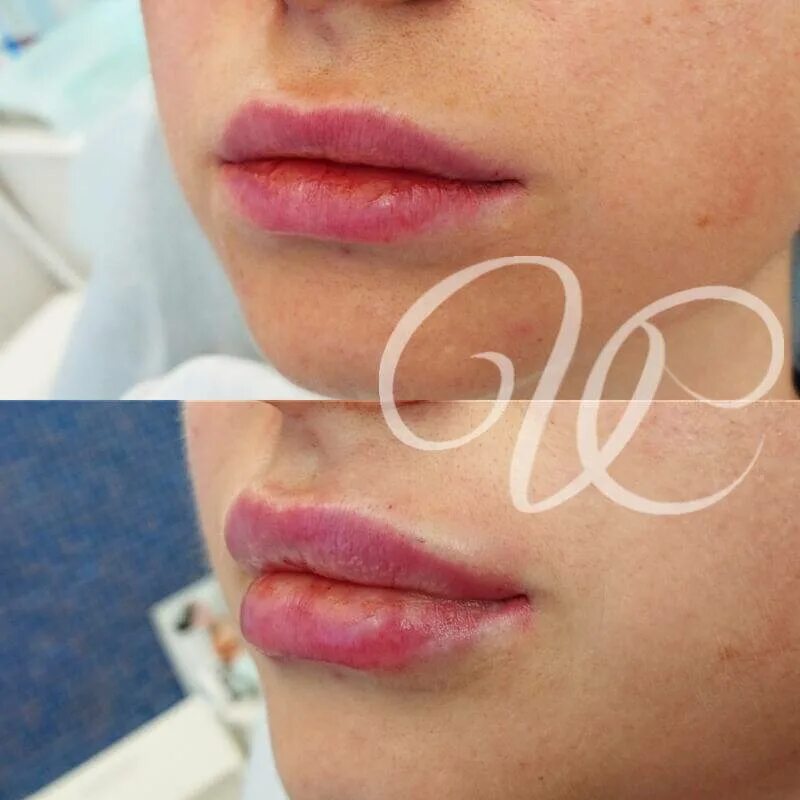 увеличение губ гиалуроновой кислотой 1 мл. губы после контурной пластики. отек губ после гиалуронки. увеличение губ до и после. губы гиалуронка 1 мл до и после.