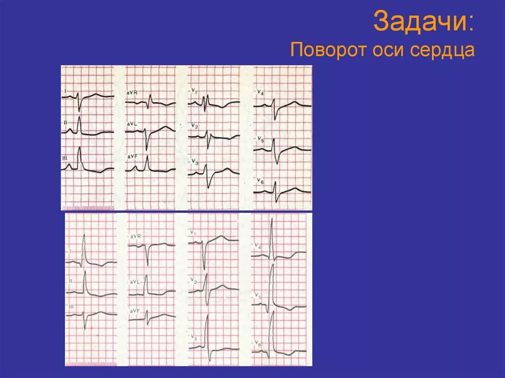 Поворот сердца верхушкой кпереди на ЭКГ. Повороты сердца на ЭКГ вокруг продольной оси. ЭКГ при поворотах сердца вокруг продольной оси. Поворот правым желудочком кпереди на ЭКГ. Сердце против часовой стрелки