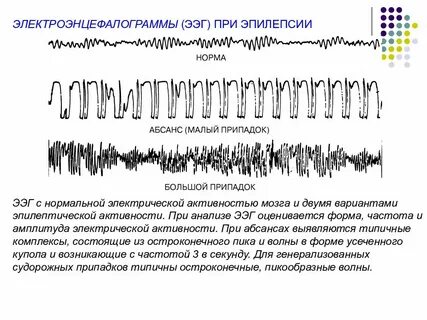Очаговая активность