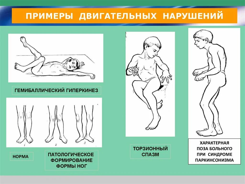 Расстройство двигательной функции. «Симптомы и синдромы двигательных нарушений». Синдром нарушения двигательной активности у грудничка. Синдром двигательных нарушений у детей. Двигательные нарушения ДЦП.