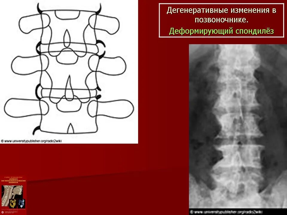 Дегенеративные поражения позвоночника. Деструктивно дегенеративное заболевание позвоночника. Деструктивно дистрофические изменения позвоночника. Деструктивные изменения в позвоночнике что это. Деструктивные изменения позвонков кт.