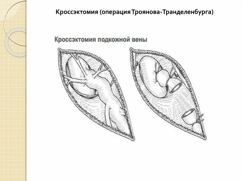 Операция мюллера минифлебэктомия. Перевязка троянова тренделенбурга. Кроссэктомия операция троянова тренделенбурга. Кросэктомия. Операция троянова-тренделенбурга.