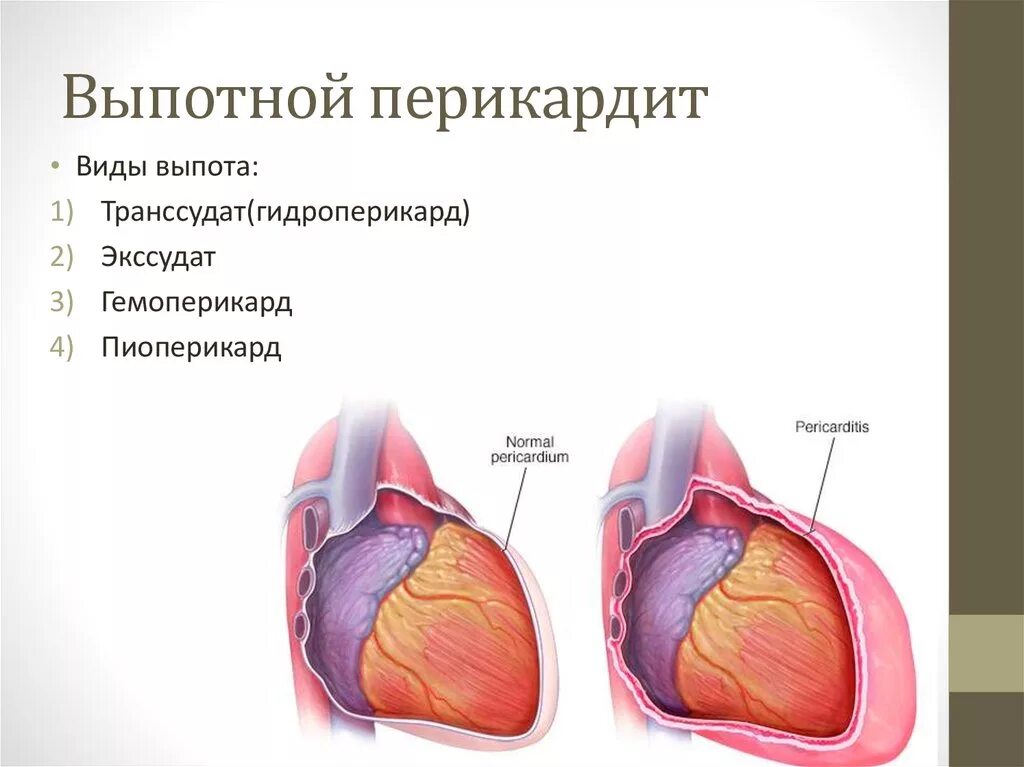 Скопление воздуха и крови в перикарде. Экссудативный перикардит выпотной. Гидроперикард и экссудативный перикардит. Перикардит гидроперикардит. Эксуддативныц перикард.