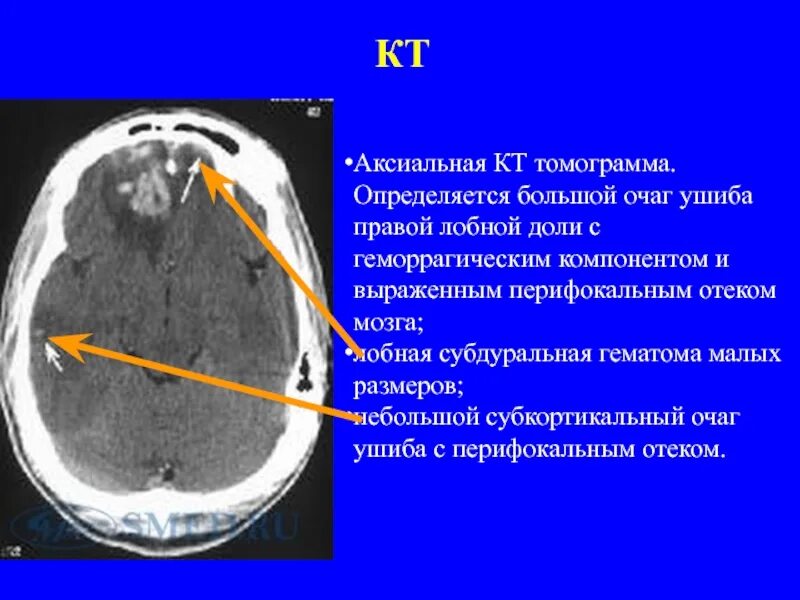 Единичный очаг в правой лобной доле