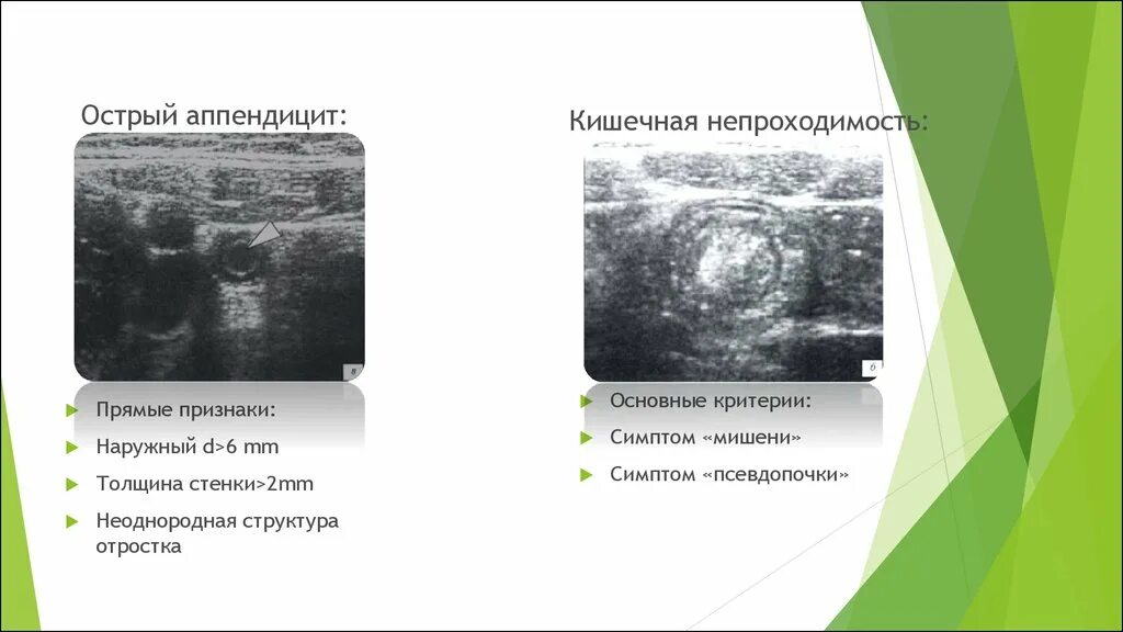 Острый аппендицит на УЗИ протокол. УЗИ червеобразного отростка протокол. Кишечная непроходимость на УЗИ.