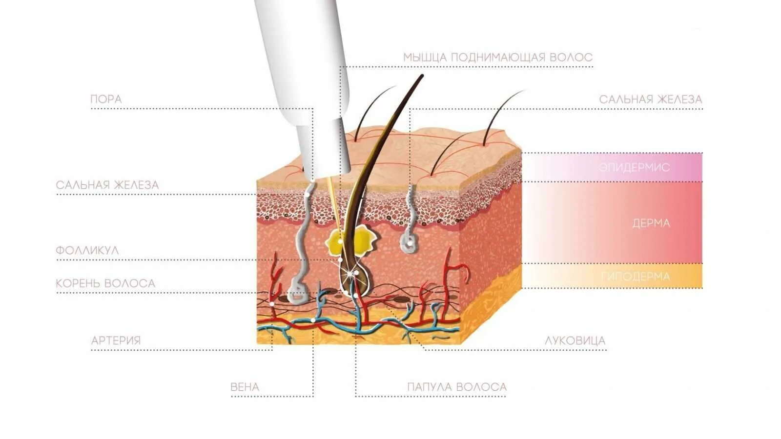 Корень волоса погружен в окруженную. Строение волоса электроэпиляция. Электроэпиляция игла в фолликуле. Строение волоса для электроэпиляции. Электроэпиляция строение кожи и волоса.