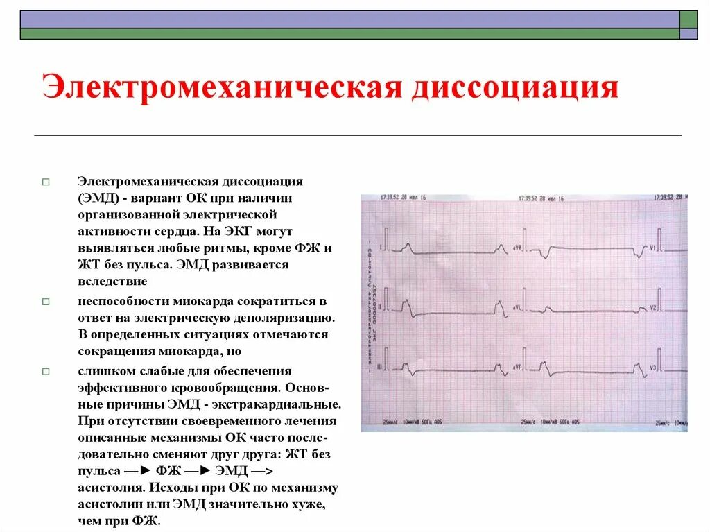 ЭКГ при электромеханической диссоциации сердца. Электромеханическая диссоциация критерии на ЭКГ. Электромеханическая диссоциация кардиограмма. ЭКГ асистолия и электромеханическая диссоциация.