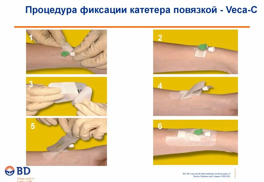 Катетер процедура. Фиксация периферического катетера. Фиксация катетера внутривенного. Повязка для фиксации периферических катетеров. Фиксатор для катетера.