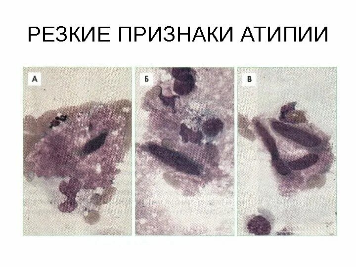 Лейкоплакия микроскопия. Признаки тканевой атипии.