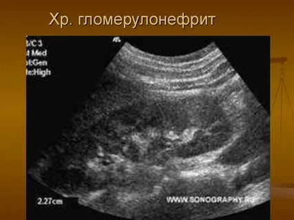 Узи почек при гломерулонефрите