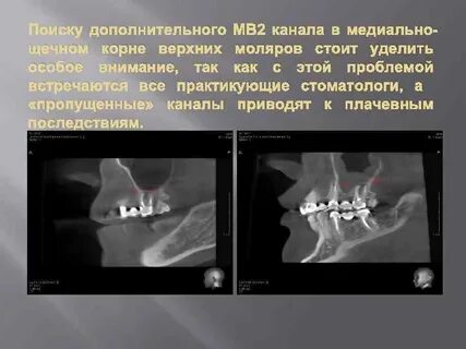 Что такое мв