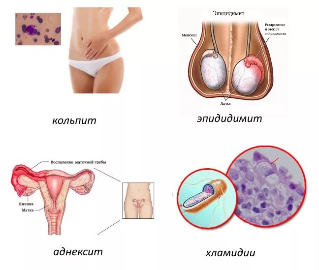 Симптомы урогенитального хламидиоза. Урогенитальный хламидиоз осложнения. Хламидиоз внешние проявления. Хламидии как выглядят