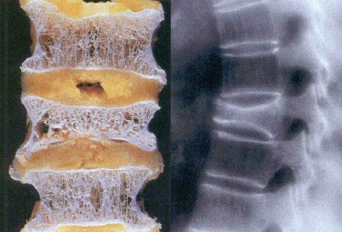 Остеопороз компрессионный перелом позвоночника. Остеопороз позвонков рентген. Рентген позвоночника при остеопорозе. В костях и т д