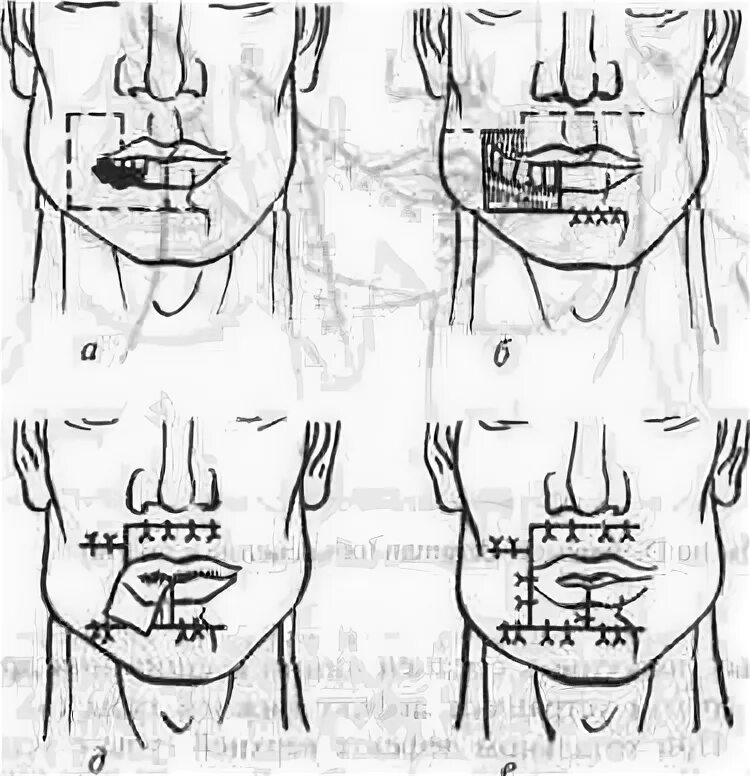 Операция нижней губы. Операция по методу Иванова. Пластика нижней губы по Иванову.