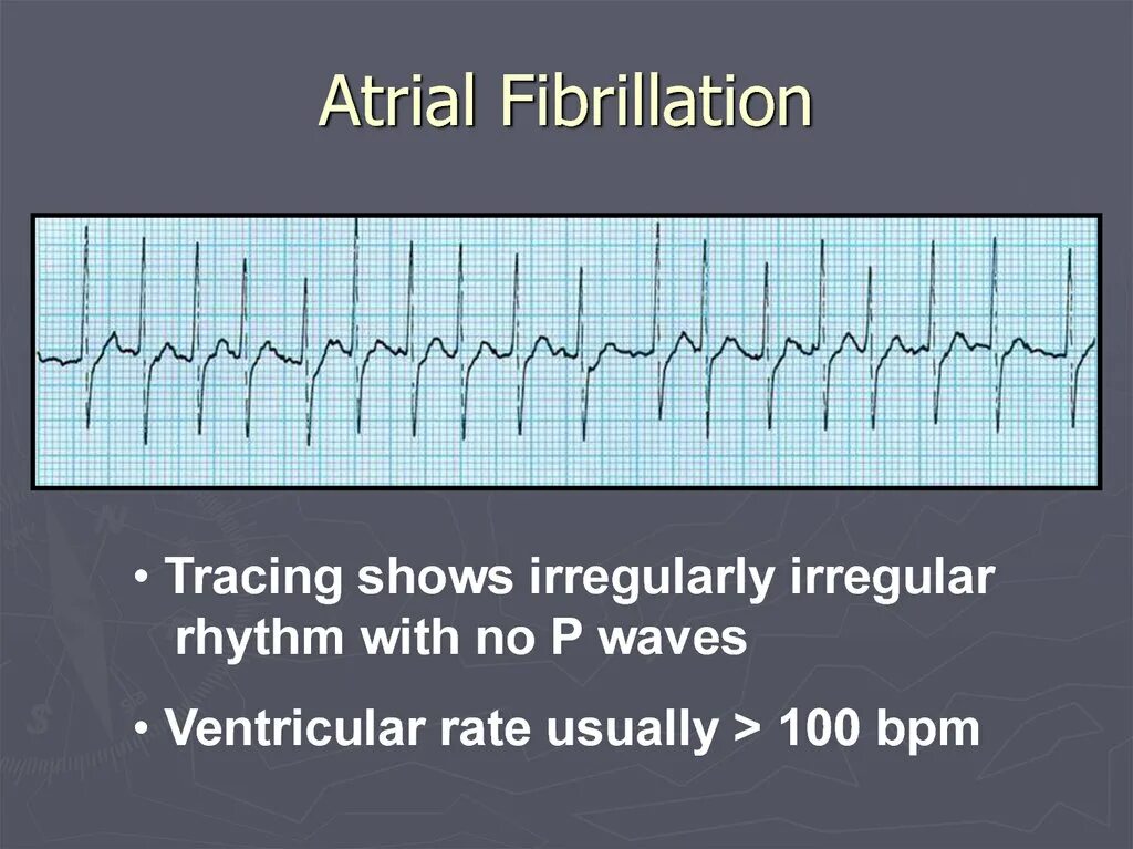 Работает fib звук. Atrial fibrillation. atrial fibrillation ehra. atrial fibrillation echocardiogram. atrial fibrillation causes.