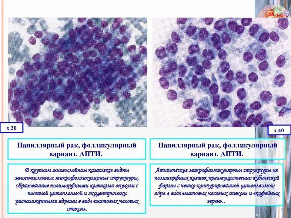 Карцинома щитовидной железы гистология. Коллоид щитовидной железы цитология. Фолликулярная карцинома гистология. Анапластическая карцинома щитовидной железы гистология. Папиллярный рак после операции