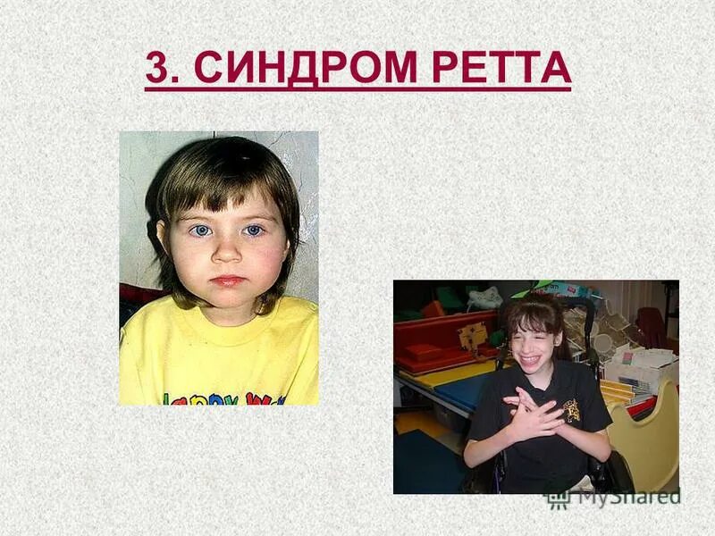 Синдром ретта причины. Синдром ретта. дети с синдромом ретта. атипичный синдром ретта. болезнь ретта.
