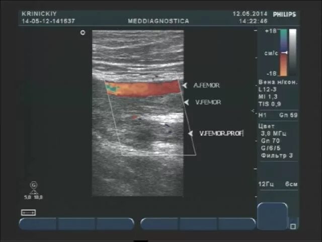 Как называется узи вен. УЗИ картина вен нижних конечностей. УЗИ вен нижних конечностей заключение. УЗИ признаки проходимости крупной вены.