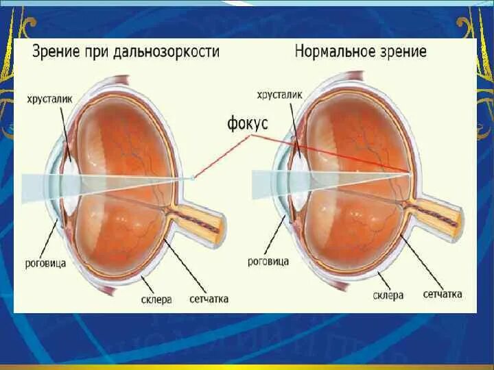 Строение глаза миопия. Близорукость строение глаза. Гиперметропия глаза это анатомия. Строение глаза заболевания близорукость. Линзы для зрения дальнозоркость