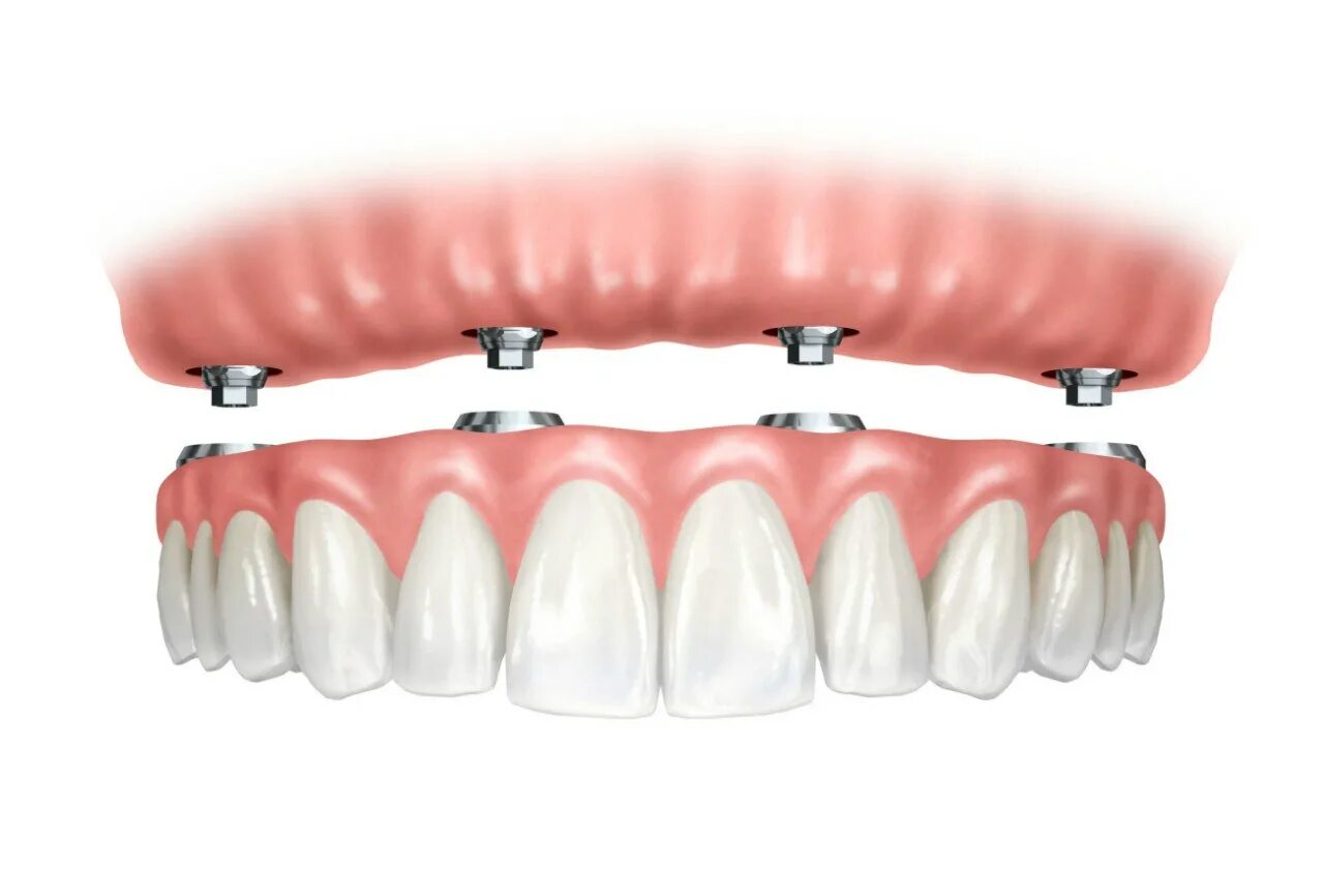 протезы на 4 х имплантах. имплантация по технологии all-on-4. балочный протез на 4 имплантах. аллон 4 протезирование. циркониевый протез на 4х имплантах.