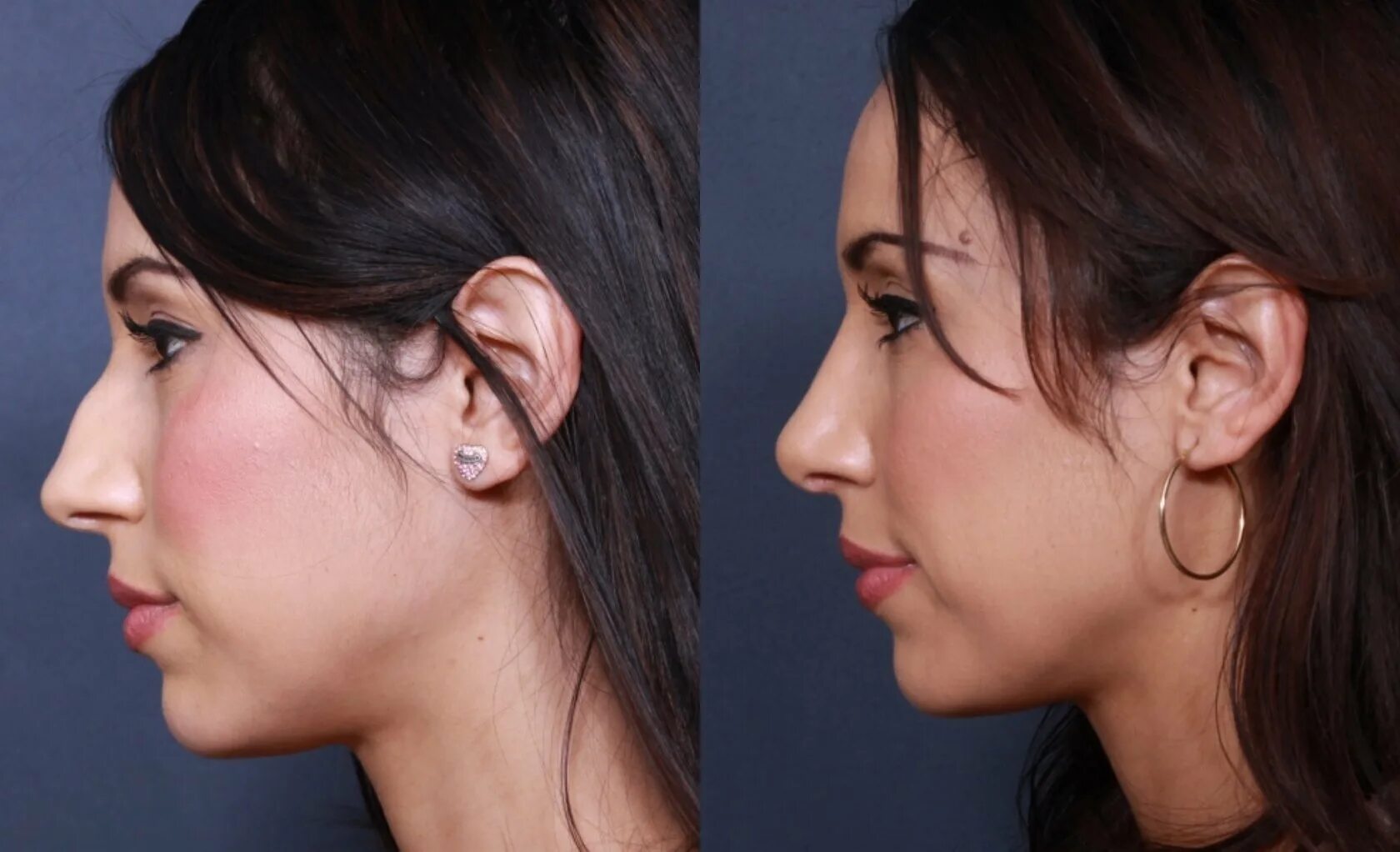 Колумелла носа операция. Идеальная форма носа. Верхняя микрогнатия мезиальный прикус. Профиль лица. Скошенный подбородок.