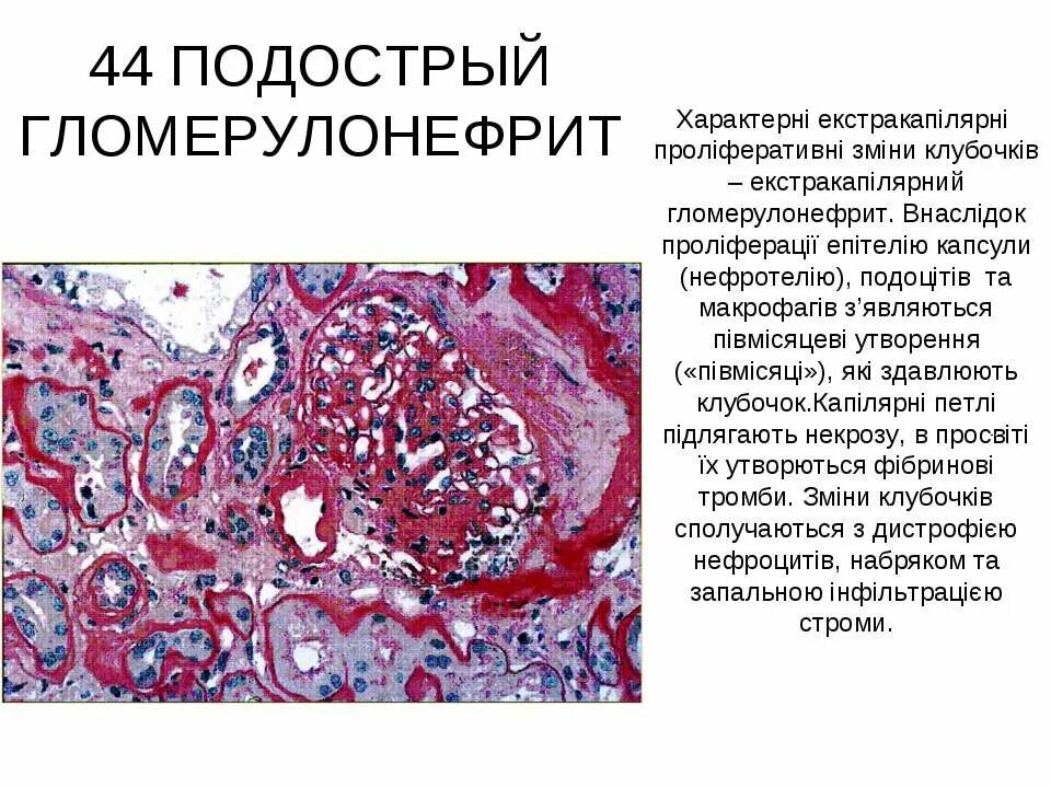 Подострый гломерулонефрит. Подострый гломерулонефрит макропрепарат. подострый гломерулонефрит полулуния. быстропрогрессирующий гломерулонефрит патанатомия. интракапиллярный продуктивный гломерулонефрит микропрепарат.