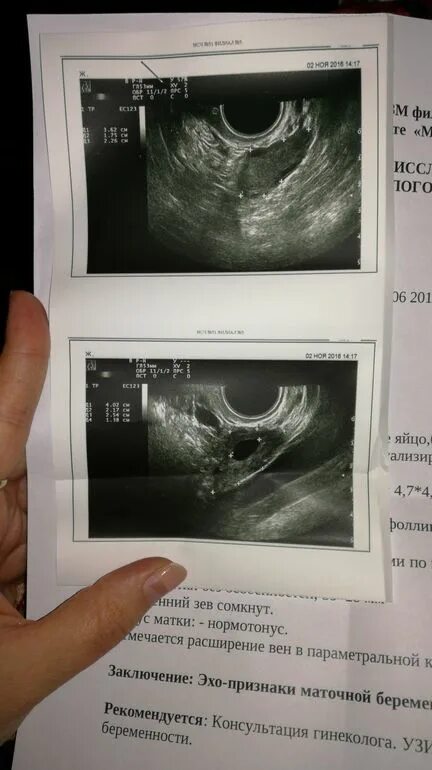 УЗИ 2 на 5-6 недели беременности. УЗИ 2.5 недели беременности фото. Срок 6 недель форум