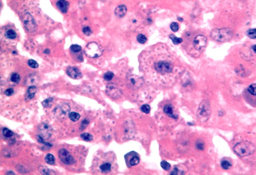 Гистоплазмоз это. Гистоплазмоз возбудитель. гистоплазмоз селезенки. histoplasma capsulatum микроскопия. гистоплазмоз и бластомикоз.