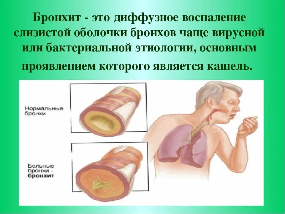 Бронхит какое заболевание. Острое воспаление бронхов. Воспаление бронхов – бронхит. Симптомы поражения бронхов.