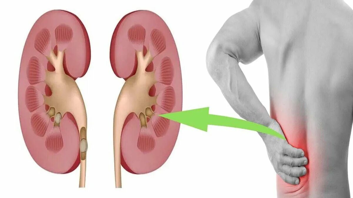 Уставшие почки. Мочекаменная болезнь почечная колика. Почечно-каменная болезнь почечная колика. Правосторонняя почечная колика. :Мочекаменная болезнь,почечный коллек.