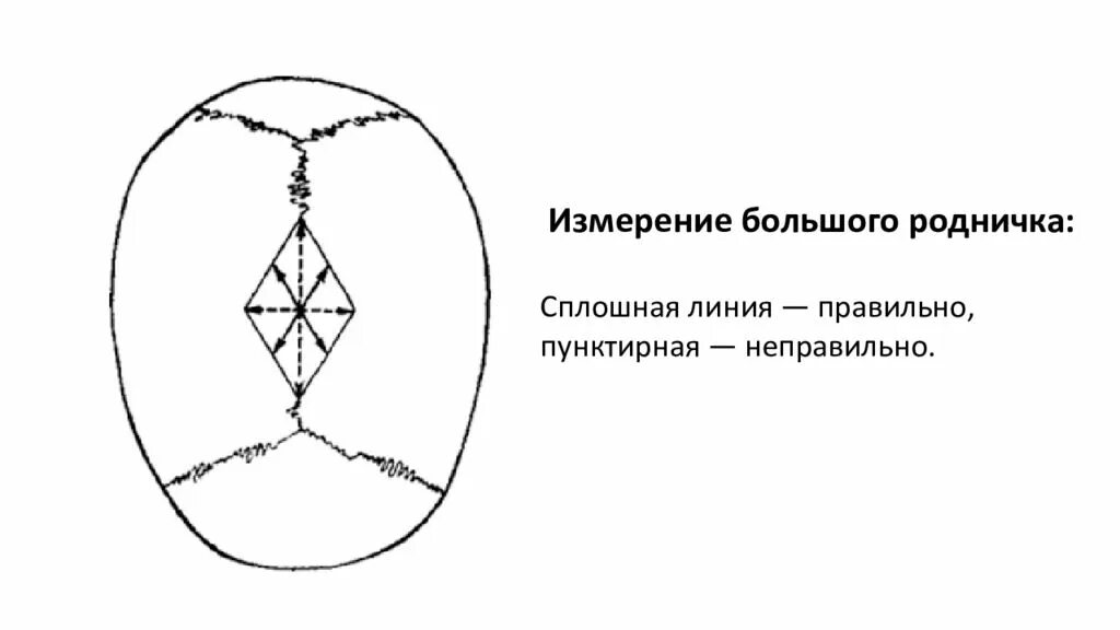 Техника измерения размеров большого родничка алгоритм. Измерение родничков у ребенка. Измерение размеров большого родничка у новорожденного.. Измерение размеров большого родничка у ребенка алгоритм.