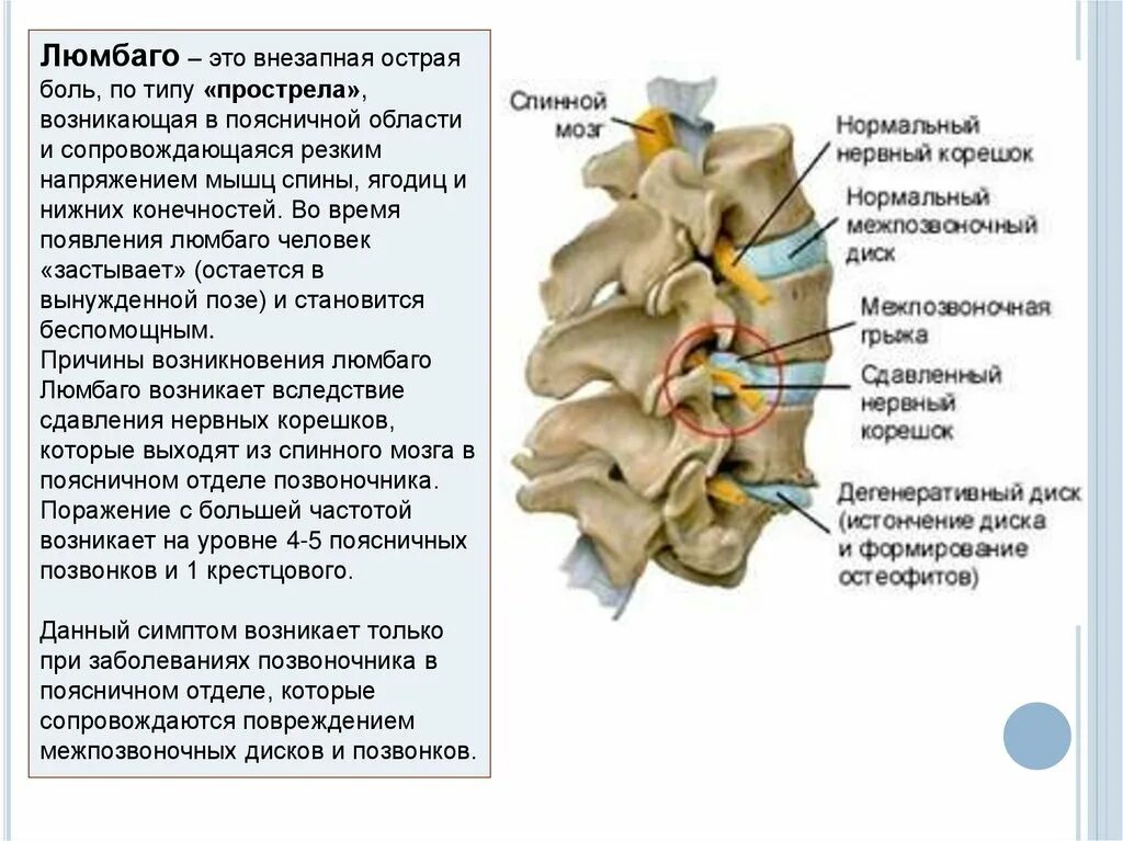 Прострелы в пояснице причины. Люмбаго. Люмбаго поясничный прострел. Люмбаго симптомы. Диагноз люмбаго.