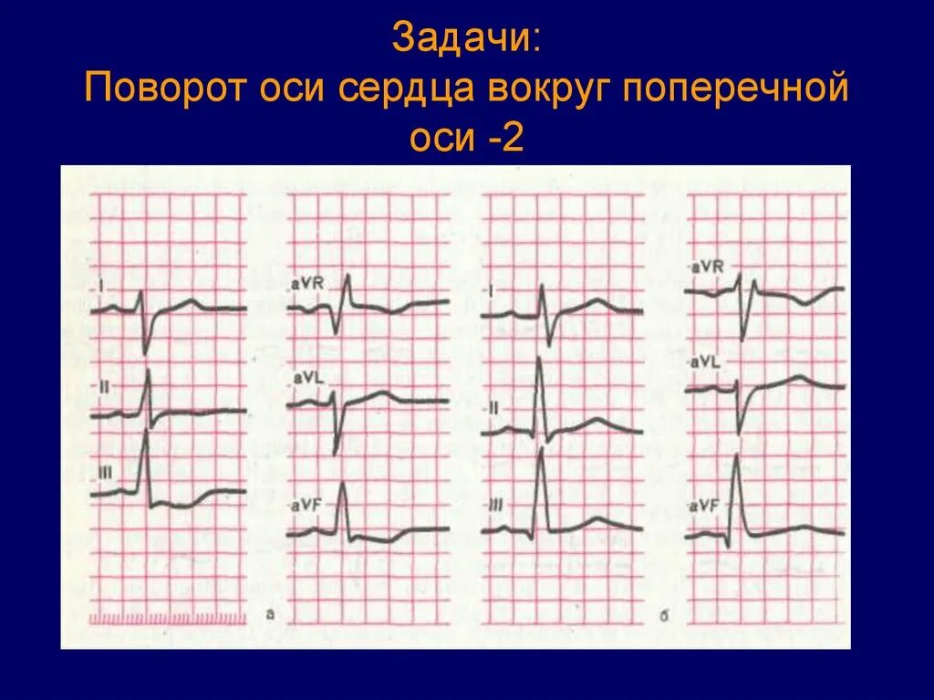 Поворот сердца вокруг поперечной оси. Поворот сердца верхушкой вперед на ЭКГ. Поворот сердца верхушкой кзади на ЭКГ. Поворот сердца вокруг поперечной оси верхушкой вперед. Сердце против часовой стрелки