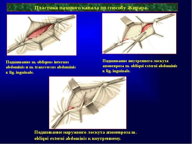 Пластика передней стенки пахового канала по мартынову. Операции грыжесечения паховая грыжа. Пластика по жирару паховая грыжа. Пластика передней стенки пахового канала. Пластика передней стенки пахового канала.